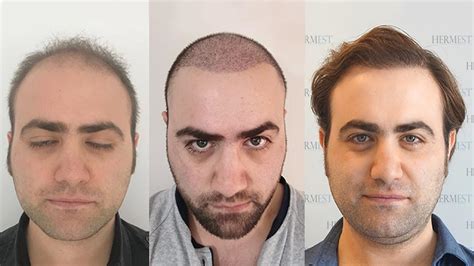 haartransplantation türkei hermest|hermest hair clinic turkey.